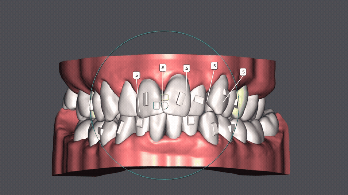 Animation der Aligner-Behandlung